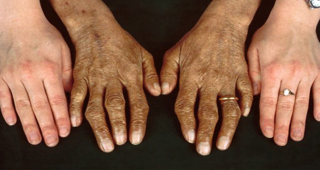 هموکروماتوز ارثی