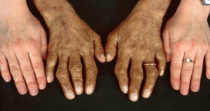 هموکروماتوز ارثی